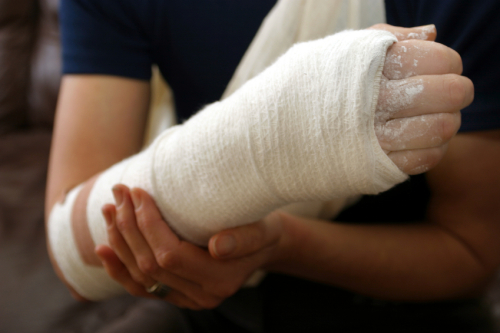 Woman With A Broken Arm   Isolated Over A