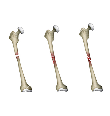 Bone Fracture Vector Art   Download Comminuted Vectors   1854918