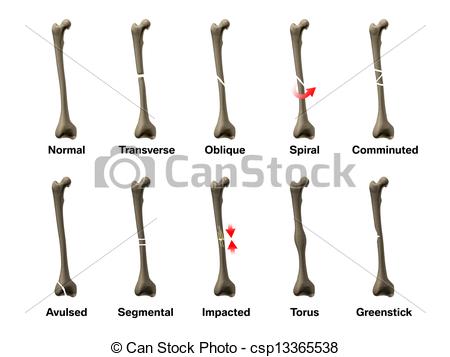 Drawings Of Bones Fractures Csp13365538   Search Clipart Illustration