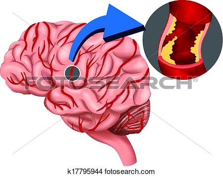 Blood Clot Concept In The Brain View Large Clip Art Graphic