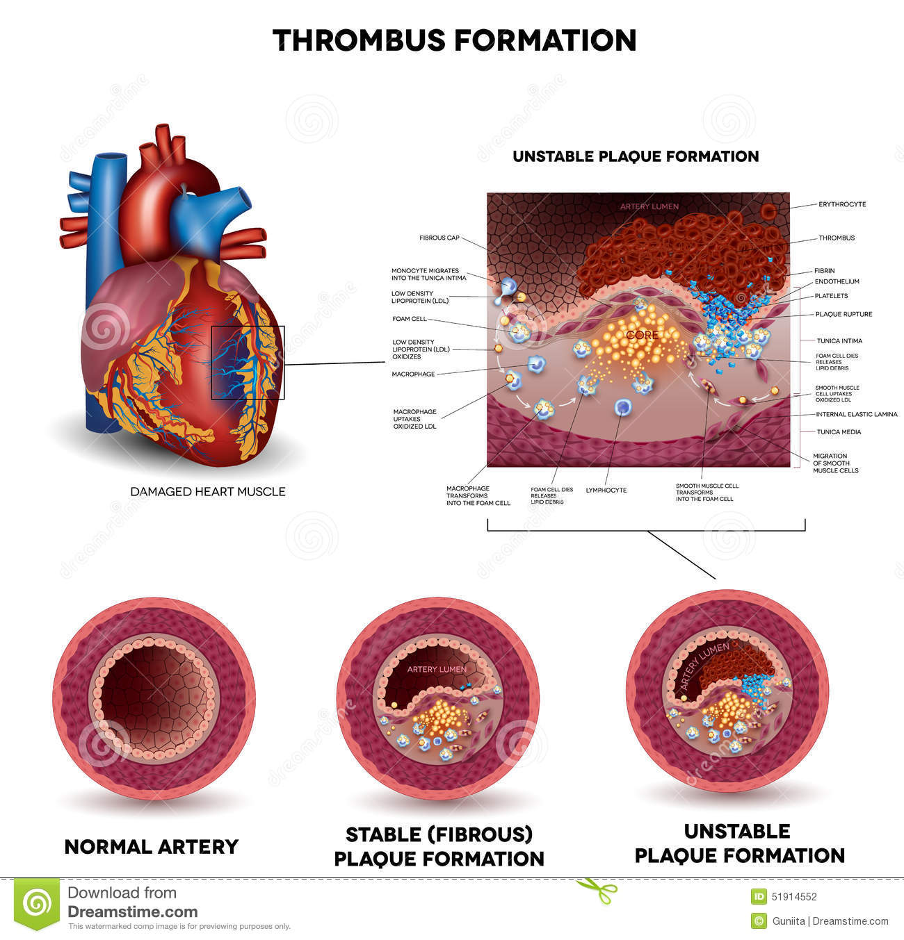 Blood Clot Formation  Coronary Artery Disease  Anatomy Of Healthy