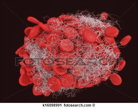 Blood Clot Thrombus Or Embolus With Coagulated Red And White Blood    