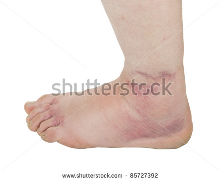 Twisted Ankle Clipart Ankle Sprain   Stock Photo