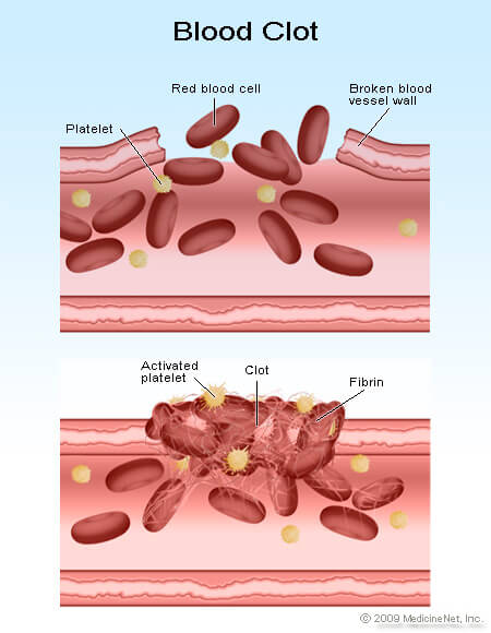 Thrombocytopenia  Symptoms And Low Platelet Count Causes