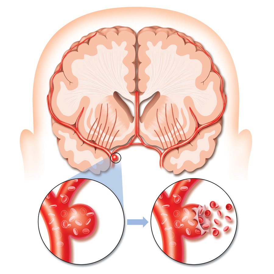 Hemorrhagic Stroke Brain