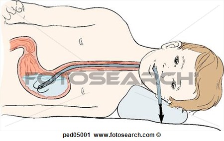 Decubitus Position  Emptying Of Gastric Contents Through Lavage Tube