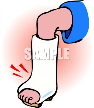 Cast Clipart 0511 1001 2606 2413 Broken Ankle In A Image Clipart