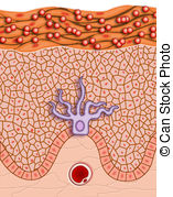 Skin Infection Illustrations And Clipart