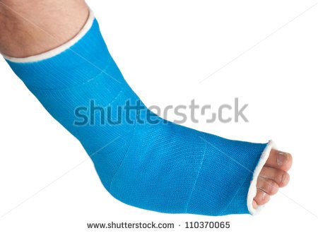 Broken Leg In A Plaster Cast Isolated On White Stock Photo Clipart