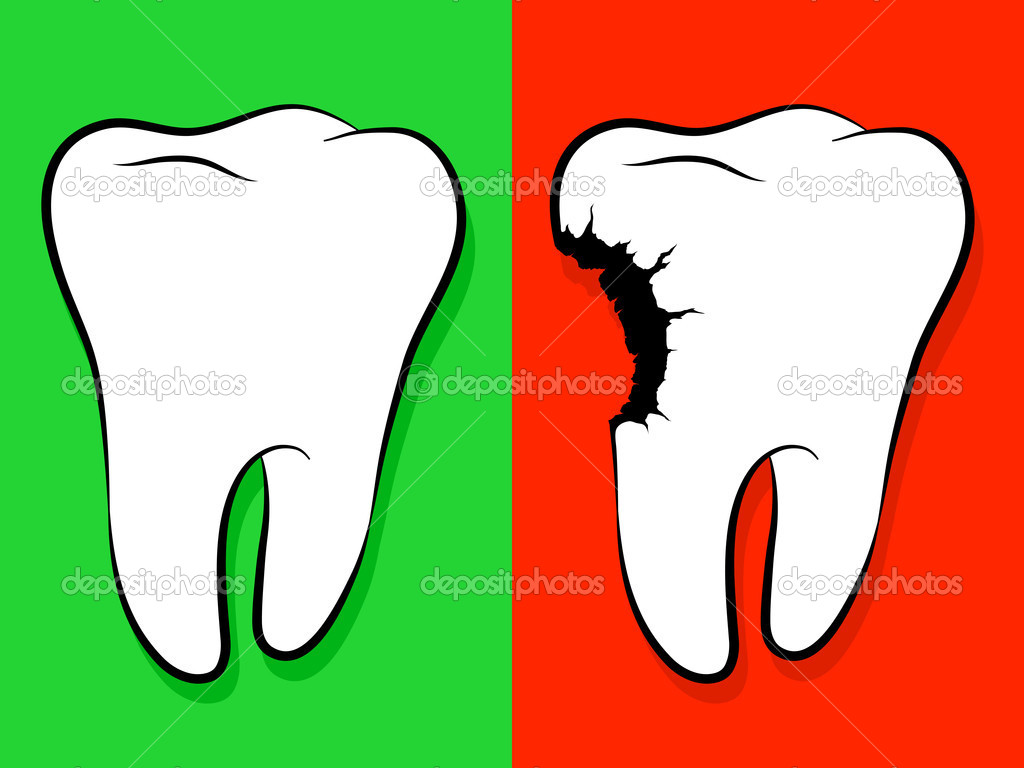 Tooth Cavity Clipart   Cliparthut   Free Clipart