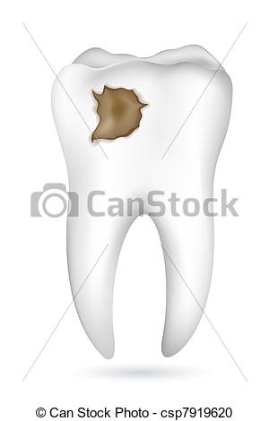 Vector Clipart Of Cavity In Tooth   Illustration Of Cavity In Tooth On