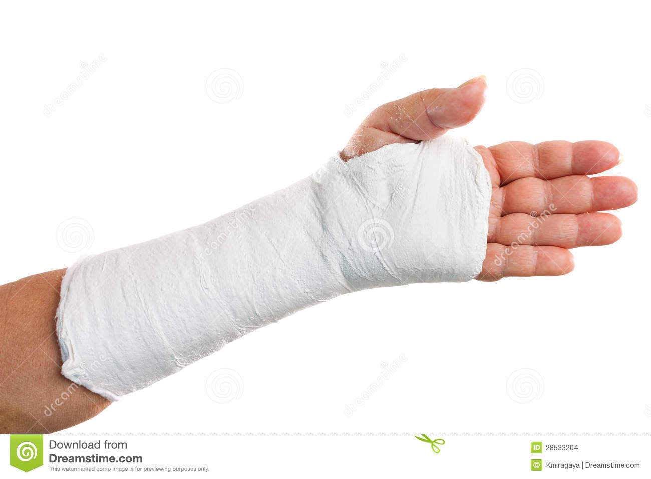 Broken Arm With A Plaster Cast Stock Images   Image  28533204