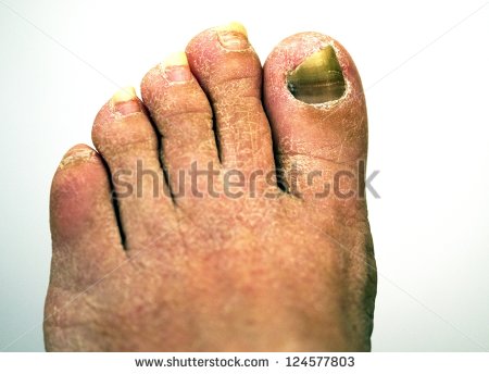 Closeup Of A Foot With Arthritis Damaged Nails Because Of Fungus And