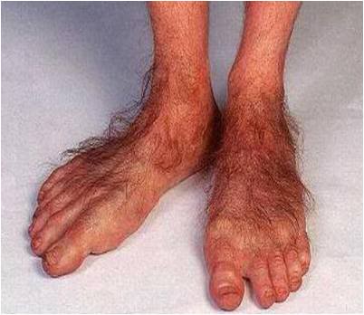 What Are Your Hobbit Feet Telling You    Lexington Podiatry