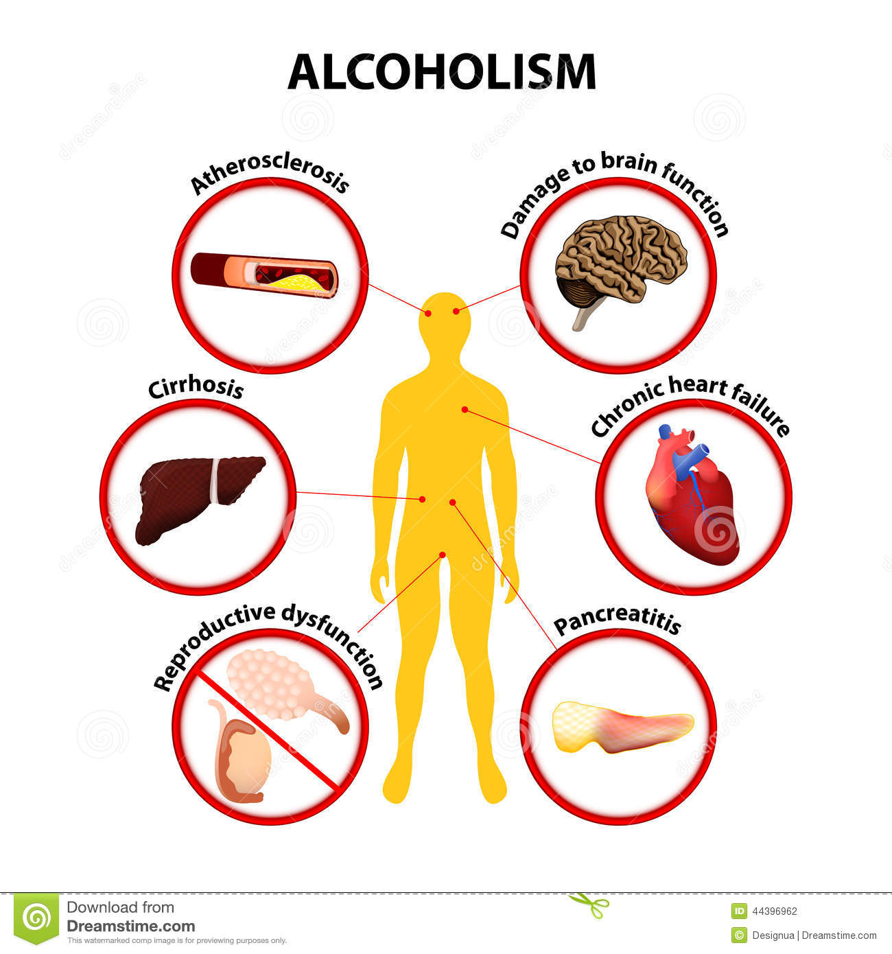 Alcoholism  Some Of The Possible Long Term Effects Of Alcohol An