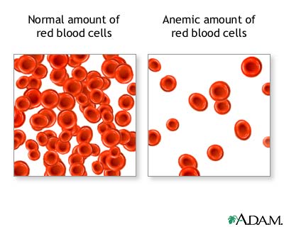 Hemolytic Anemia Symptoms Evolution And Treatment   Doctor Tipster