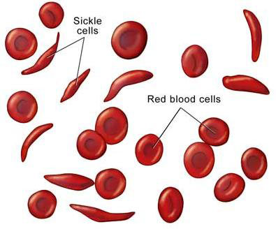 Sickle Cell Anemia   Symptoms Causes Treatment