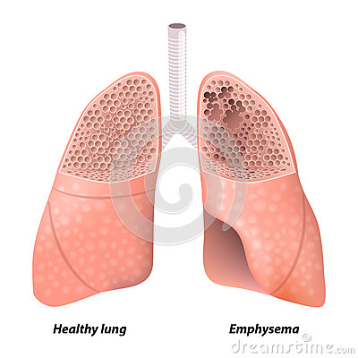 Copd Cartoons Copd Pictures Illustrations And Vector Stock Images