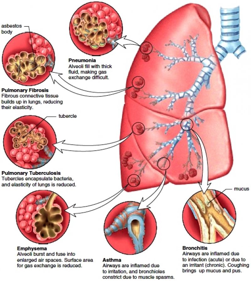 Description Asthma And Copd Chronic Obstructive Pulmonary Disease Are