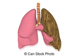 Lung Illness  Health Care Concept Stock Illustration