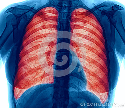 Ray Image Lung Infection Chronic Obstructive Pulmonary Disease Copd