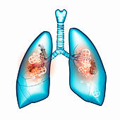 Smokers Lungs Clipart And Stock Illustrations  429 Smokers Lungs