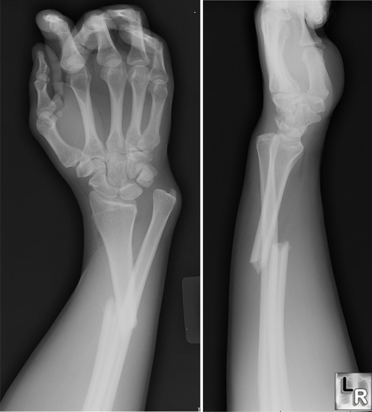 Galeazzi Fracture Consists Of A Fracture Of The Radius With Angulation    