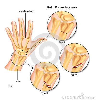 Medical Illustration Of The Various Kinds Of Fracture Of The Distal