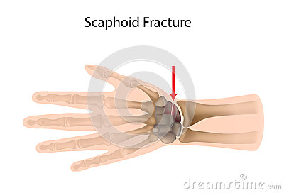 Most Common Fracture Of The Carpal Bones A Sport Injury Eps10 