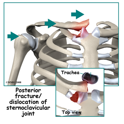 Sternoclavicular Joint Dislocation Image Search Results