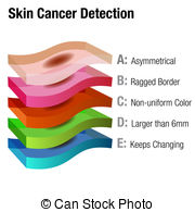 Skin Cancer Illustrations And Clip Art  608 Skin Cancer Royalty Free