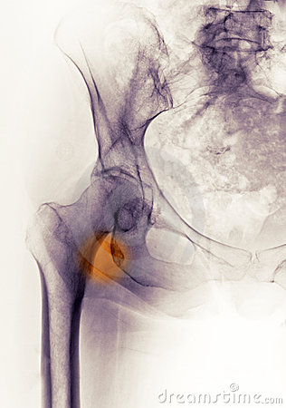 Hip X Ray Showing A Fracture Avulsion Of The Lesser Trochanter Of The