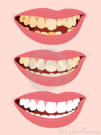Unhealthy Teeth Clipart Progressive Stages Tooth Decay
