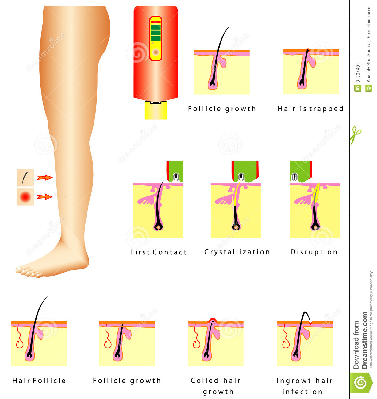 Hair Growth  Hair Is Trapped  Laser Hair Removal  Hair Removal Devices