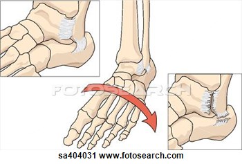 Clipart   Illustration Of Torsion Injury To Ankle With Inset  Top Left
