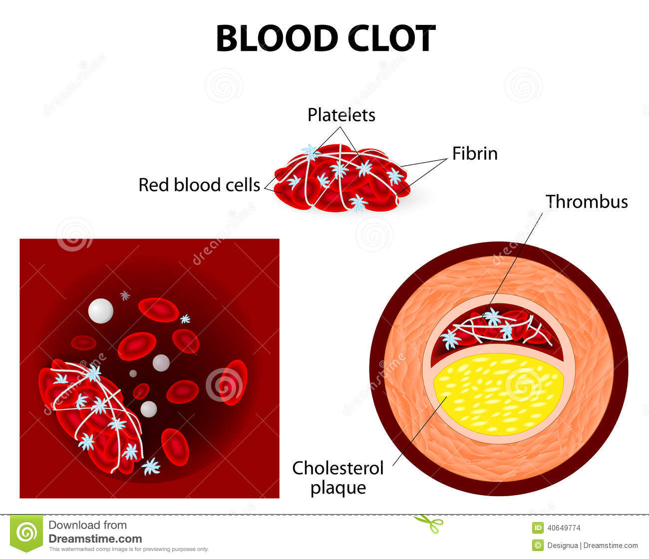 Blood Clot Forms When Blood Cells And Fibrin Clump Together  A Blood    